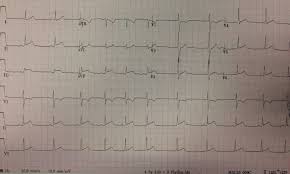 Image result for Pericarditis