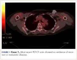 The symptoms of breast cancer vary widely among different. Two Cases Of Possible Remission In Metastatic Triple Negative Breast Cancer Mdedge Hematology And Oncology