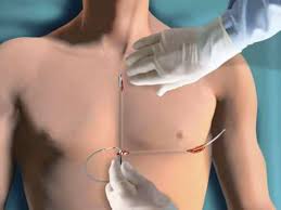 I just got my pacemaker battery changed and a s icd implanted too under my left arm pit area been out hospital 4 days recovering well i just wanted to know whoever has and s icd or icd when recovered. Video How To Install A Subcutaneous Icd System Daic
