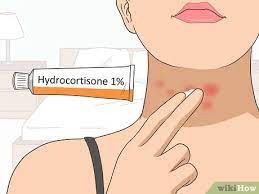 3 Ways To Treat A Rash On The Neck Wikihow