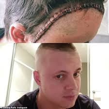 John patrick ruffo (born 8 march 1988) is an australian singer, songwriter, dancer, actor and television presenter notable for being a finalist on the third season of the x factor australia in 2011. Johnny Ruffo Dishes On Gruesome Brain Surgery Where He Was Given 27 Head Staples Daily Mail Online