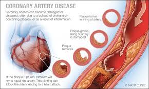 Healthy coronary arteries are smooth and elastic. Coronary Artery Disease Lingard Private Hospital