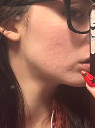 What could be causing acne-like breakouts