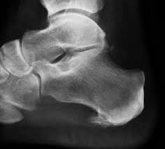Nachbehandlung nach operation der haglundferse. Fersensporn Fersenschmerz Und Entzundung Der Plantarsehne Plantarfasziitis Gelenk Klinik De