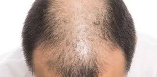 Sac Ekimi 15 Gun Sonrasi Durum Clinicexpert Uluslararasi Saglik Hizmetleri