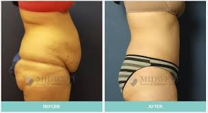 Pin On Tummy Tuck Before And After Photos