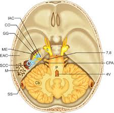 Sudut serebelloponti ,tumor, acoustic neuroma, gamma knife radiosurgery. Jaypeedigital Ebook Reader