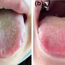 Image result for yellow tongue infection