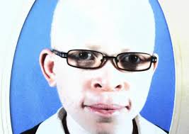 Assa wants law to protect albinos