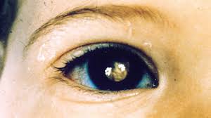 Eye, or ocular, melanoma is the most common type of eye cancer. White Spot In The Eye Causes Treatments And More