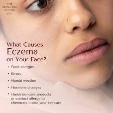 Image result for ekzema face