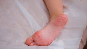 Image result for pompholyx soles of feet