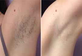 Usually, it will probably take about 10 to 15 minutes for an entire stage. Edmonton Laser Hair Removal Laser Skin Care Md Laser Skin Care Vein Clinic