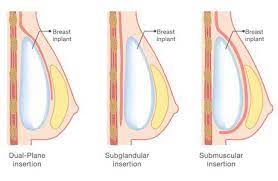 Know from expert cosmetic surgeon dr. Breast Enlargement Uplift Surgery Cost Guide