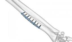 Forearm Fracture Solutions | Acumed