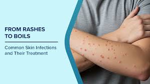 Image result for Skin Infection