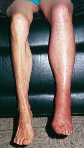 May also be caused by the activity of the physician, e.g. Tiefe Beinvenenthrombose Tbvt Via Medici Leichter Lernen Mehr Verstehen