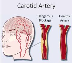 Image result for carotid artery