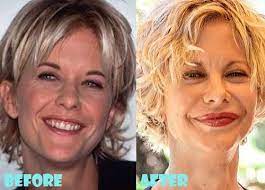 Meg ryan made an appearance at the tony awards last night, and now her face. Meg Ryan Plastic Surgery Before And After Shocking Facelift Plastic Surgery Meg Ryan Bad Plastic Surgeries
