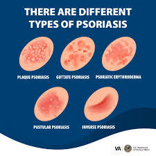 Image result for psoriasis