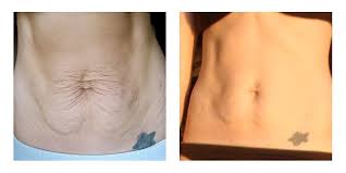 Michelle P Loose Skin Skin Brushing Dry Brushing