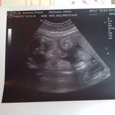 Aus reiner neugier, ab wann habt ihr das geschlecht eures babys erfahren? 3 Screening Und Endlich Das Geschlecht Erfahren Forum Fur September 2017 Mamis
