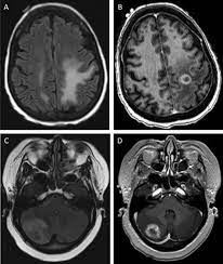 Distinguishing True Progression From Radionecrosis After Stereotactic Radiation Therapy For Brain Metastases With Machine Learning And Radiomics International Journal Of Radiation Oncology Biology Physics