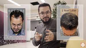 salah chatah s hair transplant experience at turkeyana clinic istanbul turkey in 2021 hair transplant clinic transplant