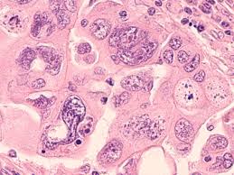 Ovarian cancer is a malignancy arising from the ovary. Subtle Signs Of Ovarian Cancer And When To See A Doctor