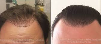 Some of the reasons why they happen include: Neograft Hair Transplants In Gainesville Fl