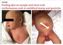 Neck rash symptoms in babies. Newborn With Desquamating Rash Mdedge Family Medicine