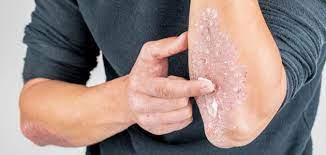 Fungal infections are common throughout much of the natural world. Ù…Ø§ Ø¹Ù„Ø§Ø¬ Ø§Ù„ÙØ·Ø±ÙŠØ§Øª Ù…ÙˆØ¶ÙˆØ¹