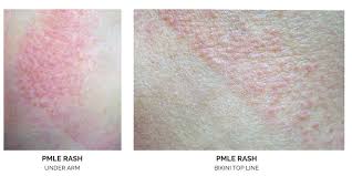 Image result for Polymorphous Light Eruption