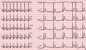 Veranderungen Des Qt Intervalls Ecg