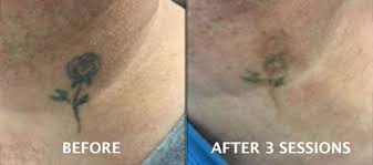 Therefore, you should be aware of all the costs involved and be ready to meet them. Tattoo Removal Dundrum