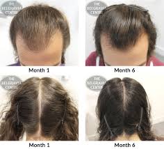 How to grow your hair faster & longer in 1 week, magical hair growth treatment.the best indian hair growth secret shared. Hair Growth Success I Really Love The Extra Thickness
