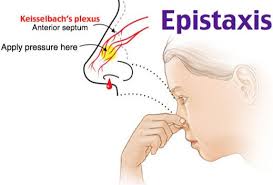 Image result for Epistaxis