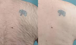 Agape medical spa and weight loss center. Laser Hair Removal Sudbury Skin Medispa Sudbury Ontario