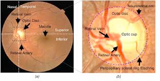 Color Image Analysis of the Optic Disc to Assist Diagnosis of Glaucoma Risk  and Evolution