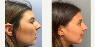 Top Rhinoplasty Doctors in Ann Arbor, MI