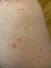 Commonly affected areas include legs, arms, buttocks, back and the beard area of the face. Can Someone Tell Me What These Red Dots Are I Have Them On My Legs And Arms My Whole Life Dermatology