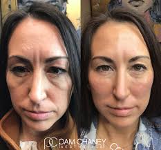 Liquid face lift using ALL RHA filler! RHA filler is uniquely dynamic and  leaves our clients with a very natural, flawless finish. 💉Treatment: RHA  Liquid Face Lift 👩‍⚕️Purpose: To restore lost volume,