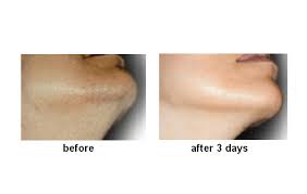 This clogging can force a hair to grow sideways (ouch), but regular exfoliation (once a. Ingrow Stopagainst Ingrown Hairs Solutions Cosmeceuticals