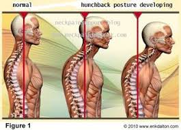 B) decompress the back of the hump. What Is The Hump On The Back Of My Neck Neck Pain Support Blog