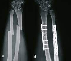 Orthoforum Unterarmfraktur