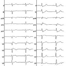 This trail starts from the parking lot 3.5 miles up camel's hump road in duxbury. Pdf Brugada Syndrome Manifested By The Typical Electrocardiographic Pattern Both In The Right Precordial And The High Lateral Leads