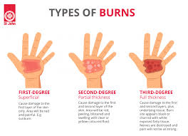 These damage your skin to the deepest layer and the tissue below it. How To Treat Recognise A Burn Effective First Aid For Burns