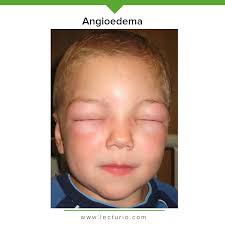 Image result for Angioedema