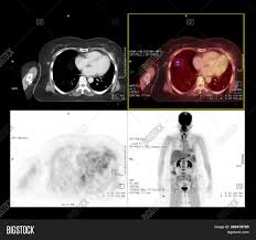 Compare pet scan costs in st. Pet Ct Scan Image Of Whole Body Comparison Axial Plane In Ct Scan And Pet Ct For Detect Cancer Recur Image Stock Photo 302479765