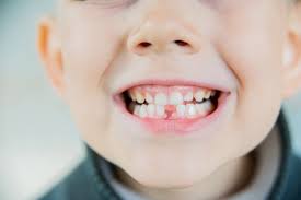 There will be less pain and less blood. Pulling Loose Teeth In Kids Versus Letting Them Fall Out Naturally Kidtastic Pediatric Dental Orthodontics City Gilbert Mesa San Tan Valley State Arizona